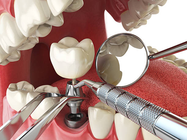 Best Emergency Denture Repair in Monrovia, IN